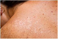 Skin Cancer and Melanoma